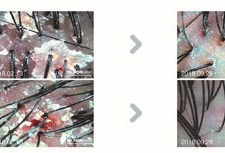 지루성두피염 7개월 관리 전/후