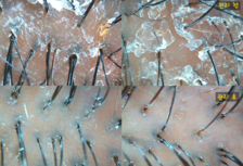 30대남성 각질, 가려움증 (체험관리 전/후 )