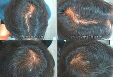 남성탈모관리 6개월 전.후