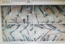 20대 남성 두피체험관리 전*후