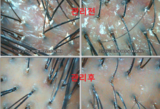 제거되지 못해 굳은 피지와 각질 체험관리 전 - 후