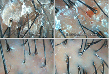 20대여성 떨어지는 비듬 유분 각질 (셀톡스케어 체험관리1회)
