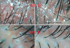 모발빠짐/가려움증/ 스트레스로인한 여성탈모고객님