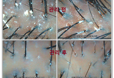 제거되지 못한 피지와 각질, 붉은 두피 체험관리 전 - 후