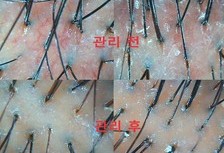 가렵고 붉은데다가 너무 민감해져 통증까지 유발했던 두피의 3개월 관리 후