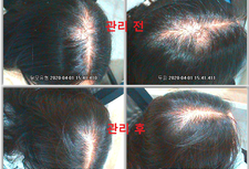 스칼프가드케어15회 20대초반여성고객님