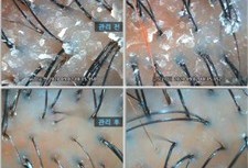 각질과 피지가 두껍게 자리잡혀있던 두피, 체험관리 후 변화는?