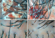과각질,진물로 인해 모발빠짐 셀톡스케어 1회체험관리
