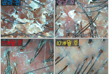 건선두피 10개월 관리 전/후