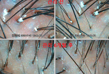 20대 남성 셀톡스 케어 6개월 후 ! + 퓨리토닉 사용