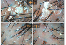두피관리 2개월 전후 비교사진 / 두꺼운 피지막, 두피가려움, 과도한유분, 냄새
