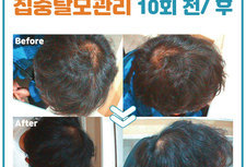 20대 남성고객님 집중탈모관리 전/ 후