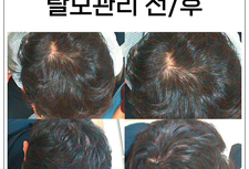 중년 남성 탈모관리 전 - 후