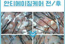 안티에이징 케어 전/ 후
