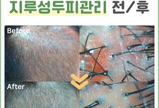 지루성두피관리 전/ 후