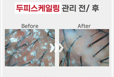 두피스케일링관리 전/ 후