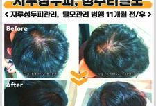 지루성두피로 인한 정수리탈모 관리 전/ 후