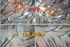 과각질/붉음증/가려움증 안티에이징12회