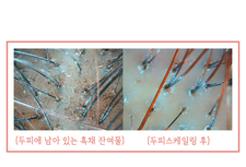 두피에 남아 있는 흑채 잔여물 두피스케일링 전/ 후