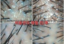 비듬관리 체험 전/ 후