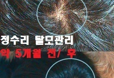 20대 남성 정수리탈모 약 5개월관리 전/ 후