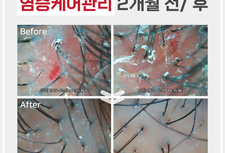 염증케어 전, 후 비교사진