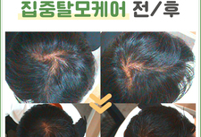30대남성 탈모관리 전/후 비교