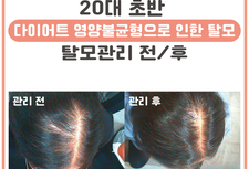 20대 초반 여성 탈모관리 전/후