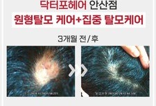 20대남성 원형탈모 3개월관리 전/후