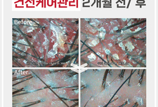 건선케어관리 2개월 전/ 후