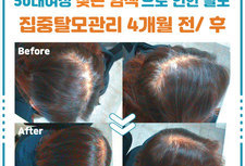 50세 여성탈모 4개월 집중탈모관리 전/ 후