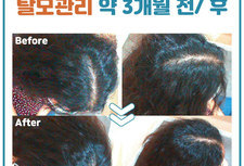 여성가르마탈모 약3개월관리