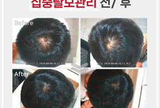 30대남성 집중탈모관리 전/ 후