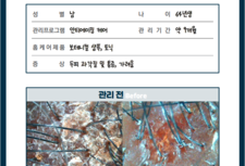 두피 과각질 남성 / 안티에이징 케어 9개월