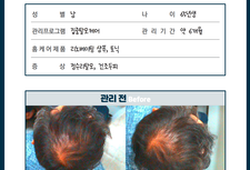 남성 탈모관리 전/ 후