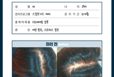 여성탈모관리 전/후