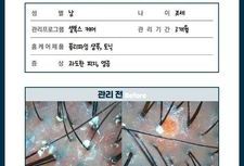 과도한피지 / 염증 셀톡스케어 3개월