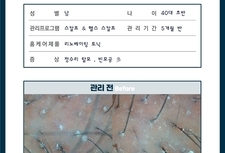 40대 남성 정수리 탈모 5개월 관리 후