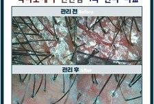겹겹이 쌓인 각질 , 두피 가려움 , 통증 잡기