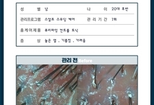 민감하고 가려운 두피 관리 7회 전 - 후