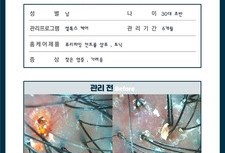 심각한 두피 염증 관리 6개월 후