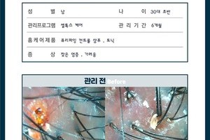 심각한 두피 염증 관리 6개월 후