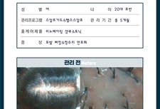 가르마 탈모 관리 5개월