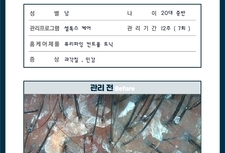 전체적인 과각질 , 20대 남성 케어 7회 관리 전/후