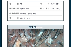 전체적인 과각질 , 20대 남성 케어 7회 관리 전/후